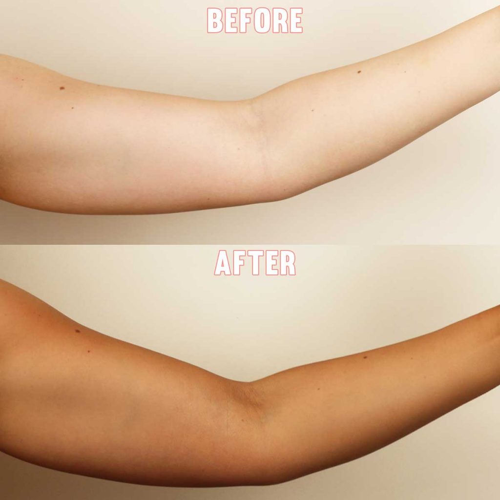 ARMS TANNING