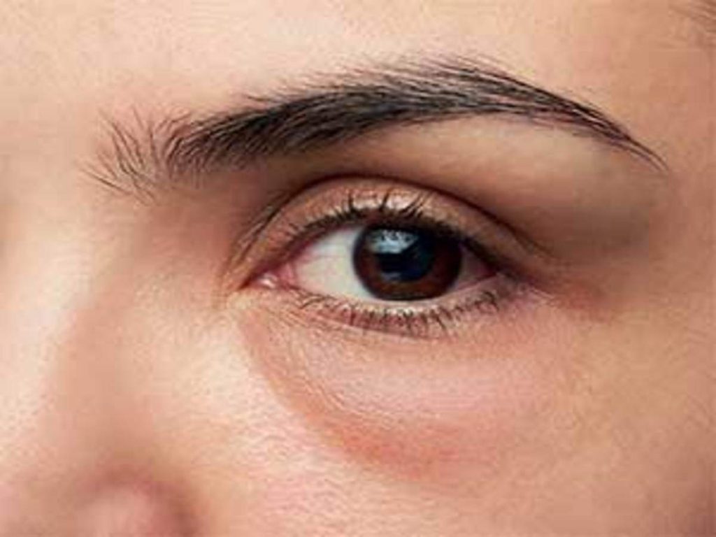 PUFFY EYES SOLUTION