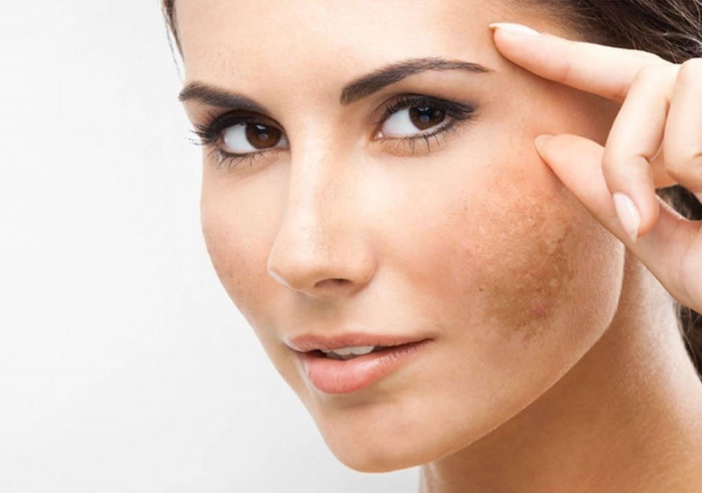 Freckles Removal Tips 